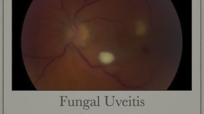 Fungal Uveitis